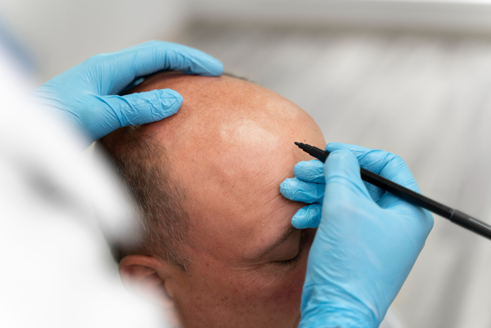 Follicular Unit Extraction